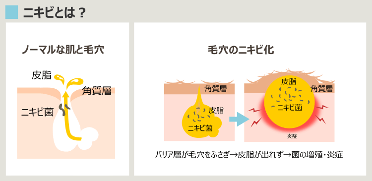 ニキビができる過程