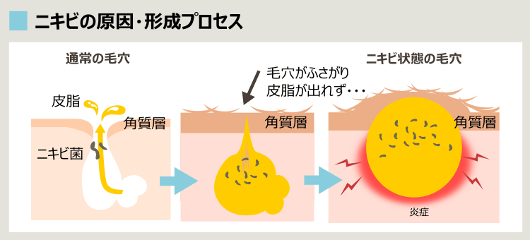 ニキビができるプロセス