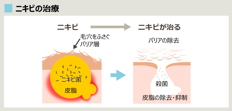 ニキビ治療のアプローチ