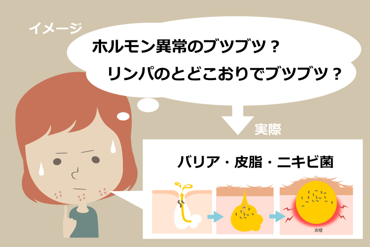 Uゾーンニキビに多い誤解