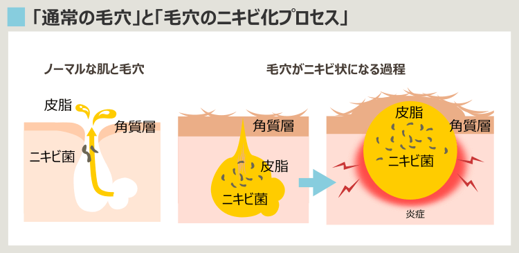 50歳のニキビ形成プロセス