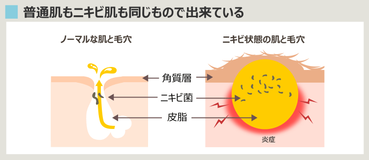 ニキビができる肌のバランス