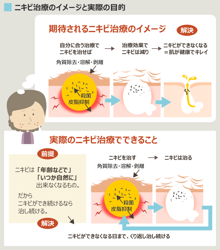 大人ニキビの治療で多い誤解