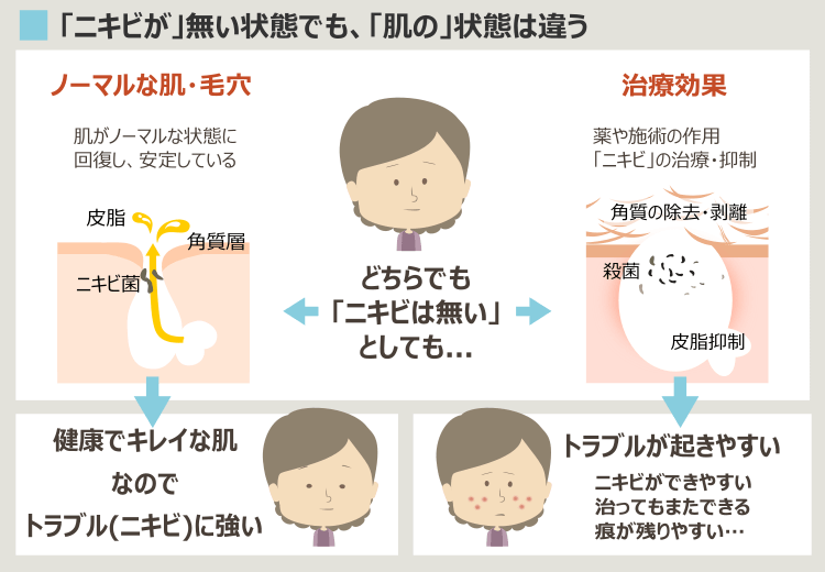 正常な肌とニキビ治療が効いている肌の違い