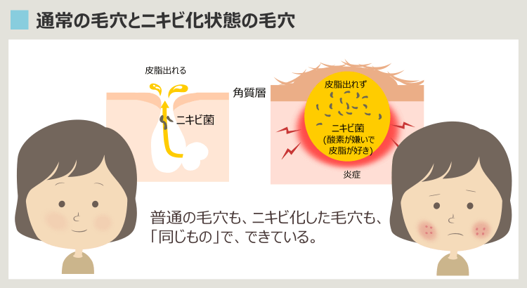 通常の毛穴とニキビ状態の毛穴