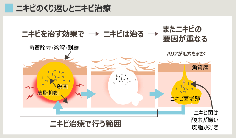 ニキビのくり返しの解説