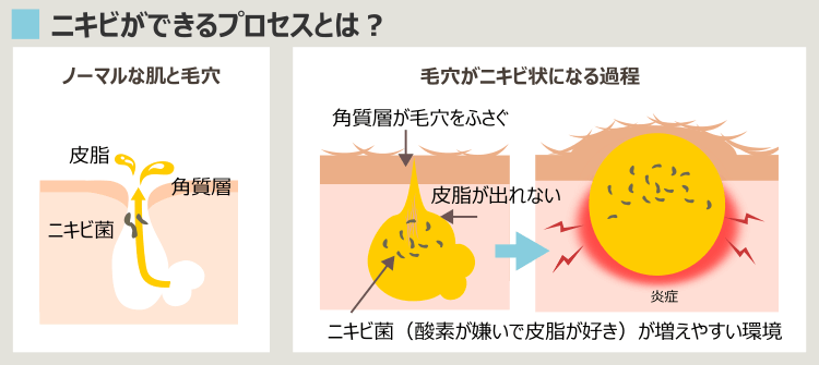 ニキビができる過程