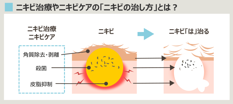 ニキビが治る過程