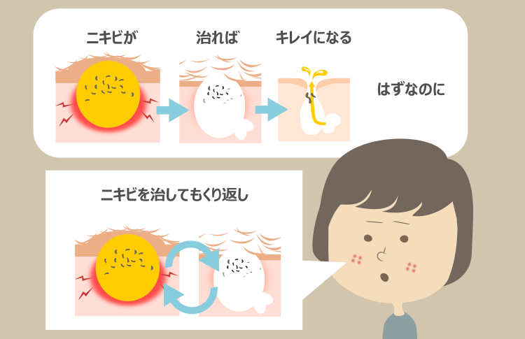 ニキビは治れば解決するのか？