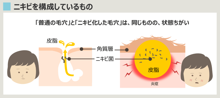 普通の毛穴とニキビの毛穴