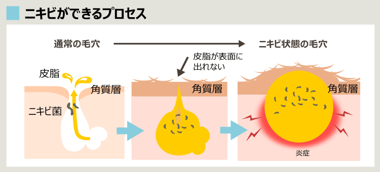 ニキビのプロセス