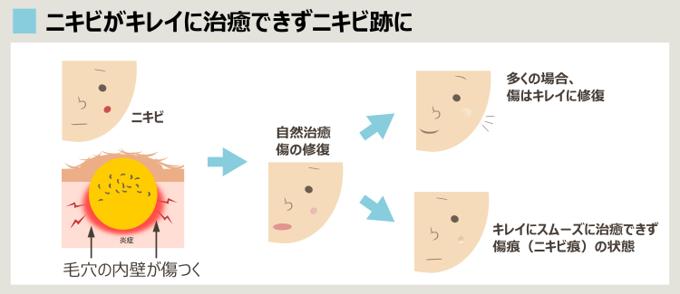 ニキビ痕が残る理由