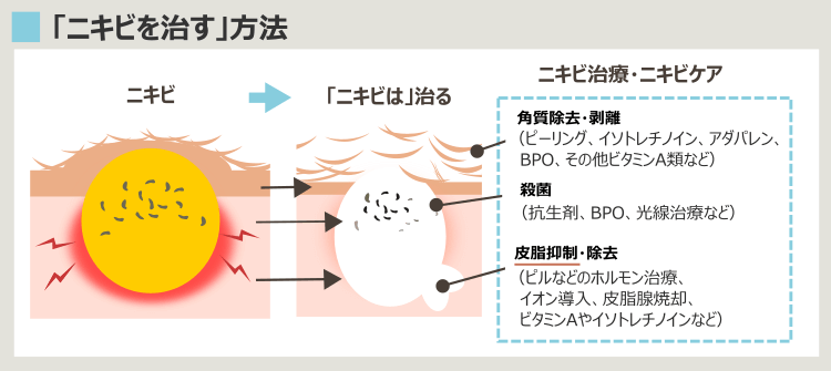 ニキビ治療と、ホルモン治療の位置づけ