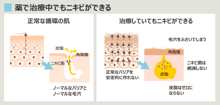 ディナゲストでもニキビができる状態の肌