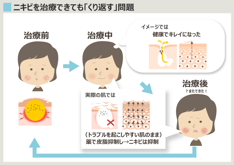 仮にディナゲストが効いても、服用後にニキビが再発するケースの解説