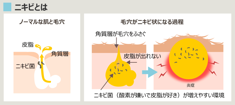 毛穴とニキビの関係