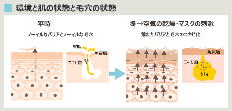 肌の状態と毛穴・ニキビの関係