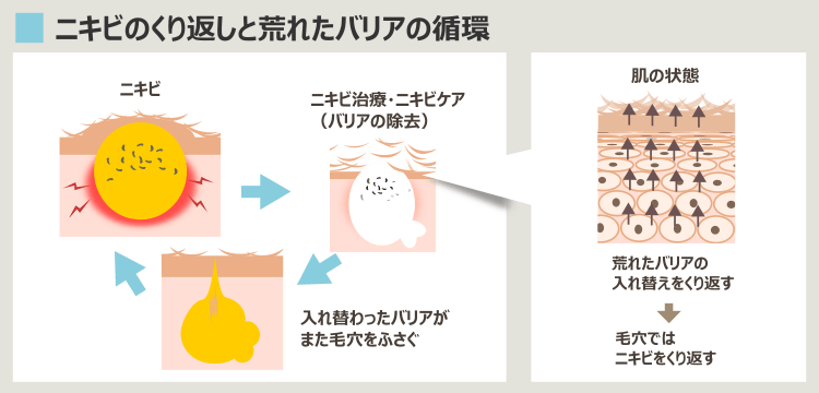 ニキビ治療のくり返しと肌の状態