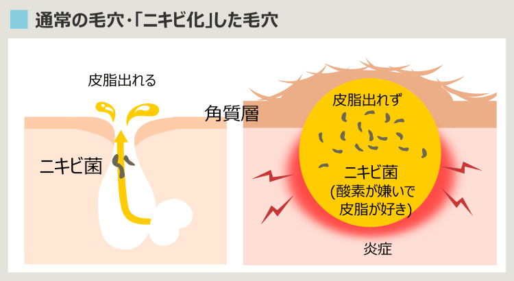 ニキビのプロセス