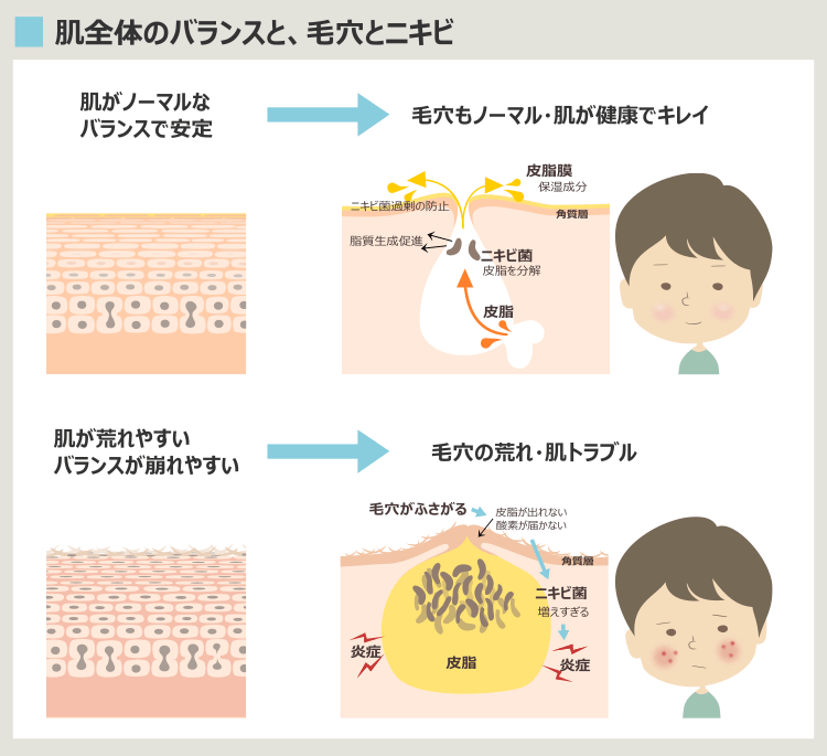 肌のバランスと毛穴のニキビ化