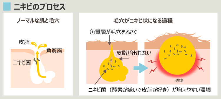 更年期ニキビのプロセス