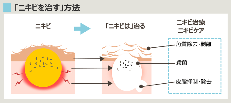 更年期ニキビの治療法