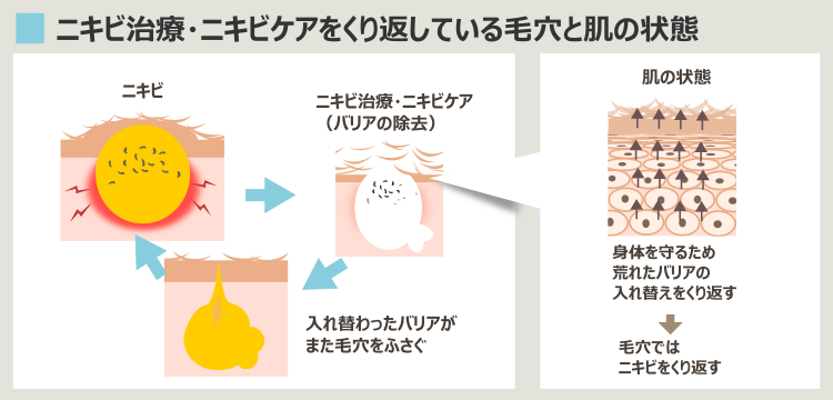 長期的なニキビ治療のダメージの蓄積