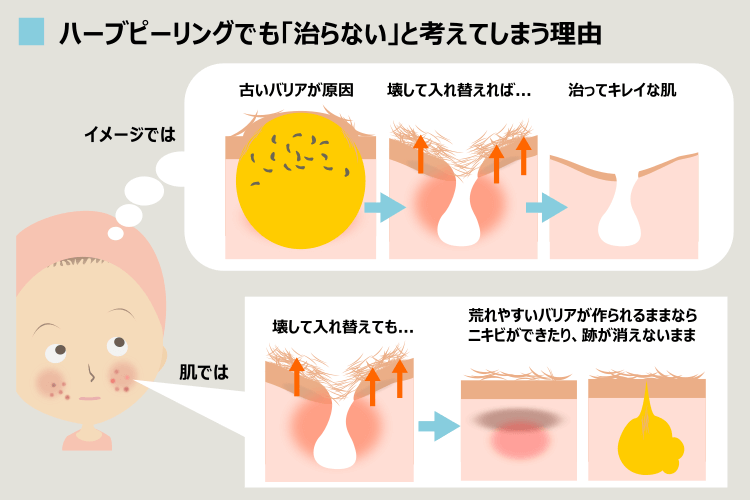 ハーブピーリングでニキビ悪化 ニキビ跡も増えるご相談