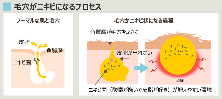 ニキビのプロセス