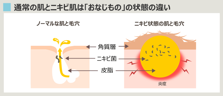 普通の毛穴とニキビ化した毛穴