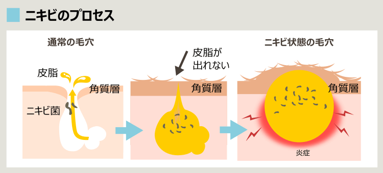 毛穴のニキビ化プロセス