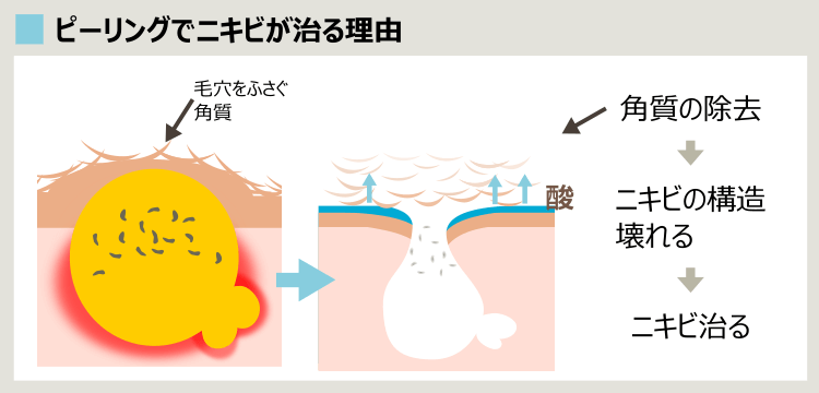 ニキビに対するピーリングの効果