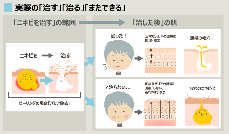 ピーリング効果の範囲とニキビ治療後の肌