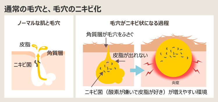 ニキビができる過程