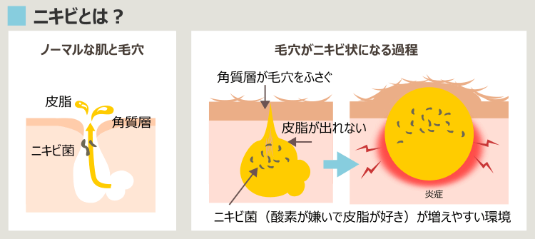 ニキビとは？ニキビ形成のプロセス