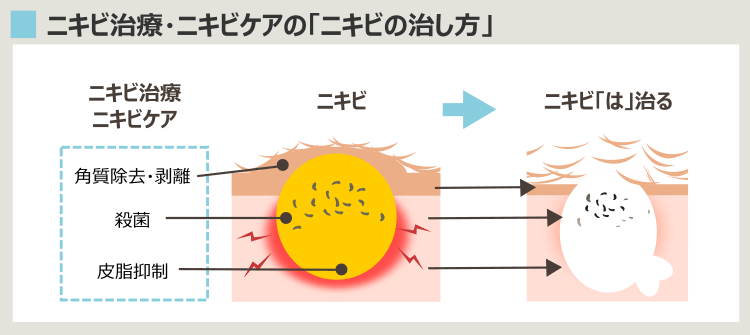 ニキビの治療方法と効果