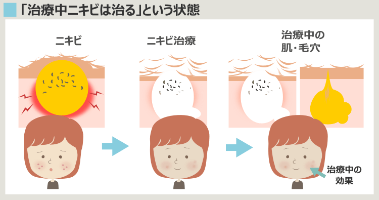 「ニキビの治療中の効果」と「ニキビの解決」の違い