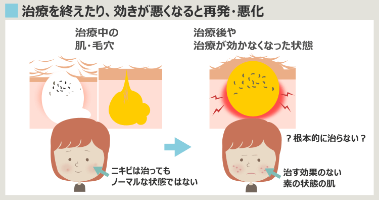 治らないニキビの正体は、治してもくり返す循環