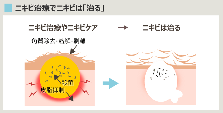 ニキビ治療の方法