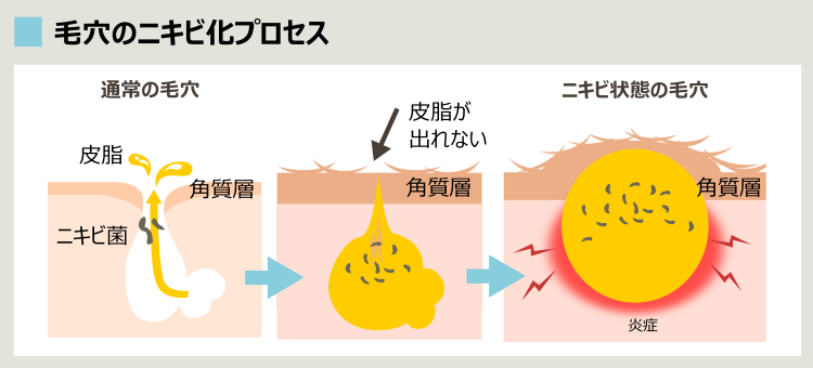 毛穴のニキビ化プロセス