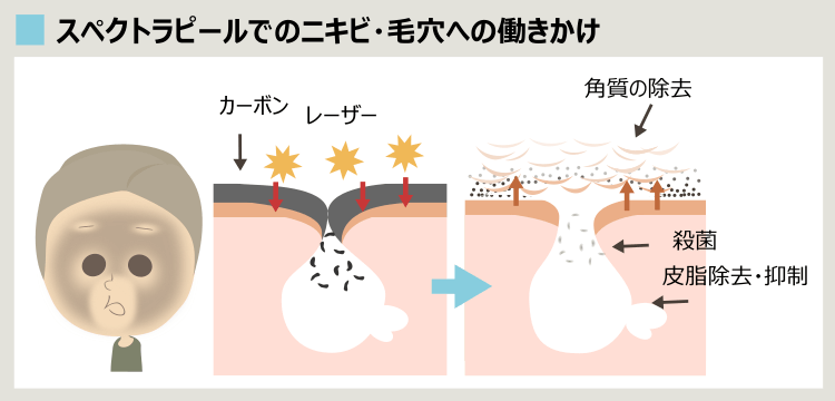 スペクトラピールでのニキビ治療効果