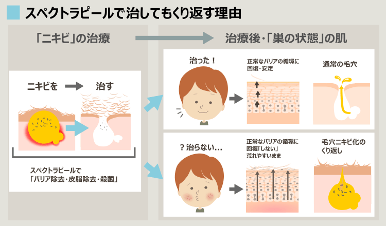 スペクトラでもニキビが治る理由と治らない理由