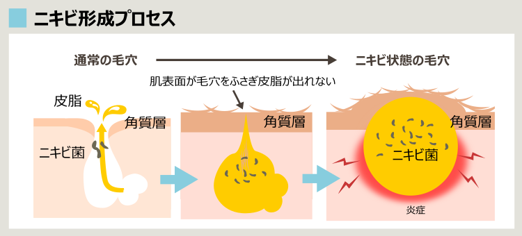 毛穴がニキビになるプロセス