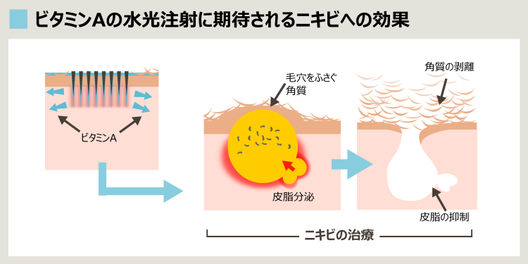 ビタミンAやヒアルロン酸でのニキビ水光治療の説明