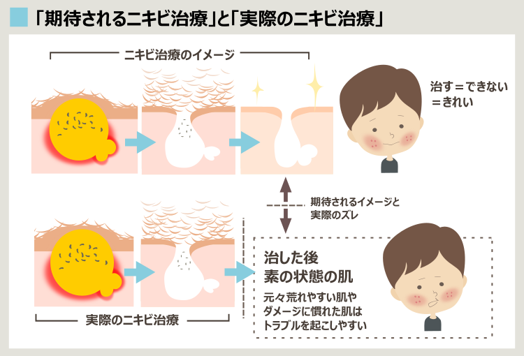 水光治療でもニキビが治らずくり返す理由