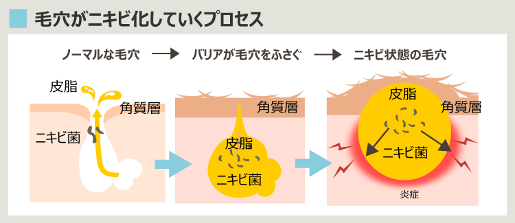 ニキビの原因