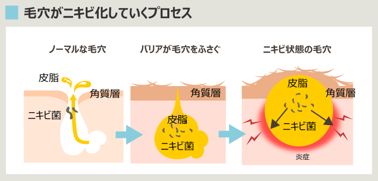 毛穴ニキビ化のプロセス