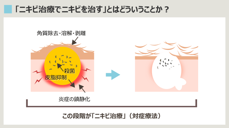 ニキビ治療効果