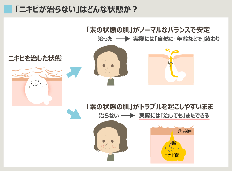 トラネキサム酸で治療しても、またニキビができる理由